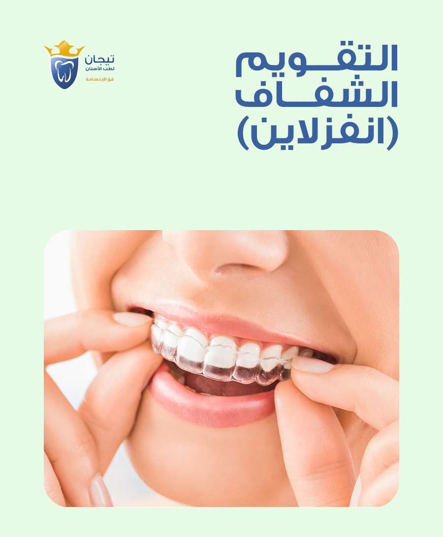 التقويم الشفاف
