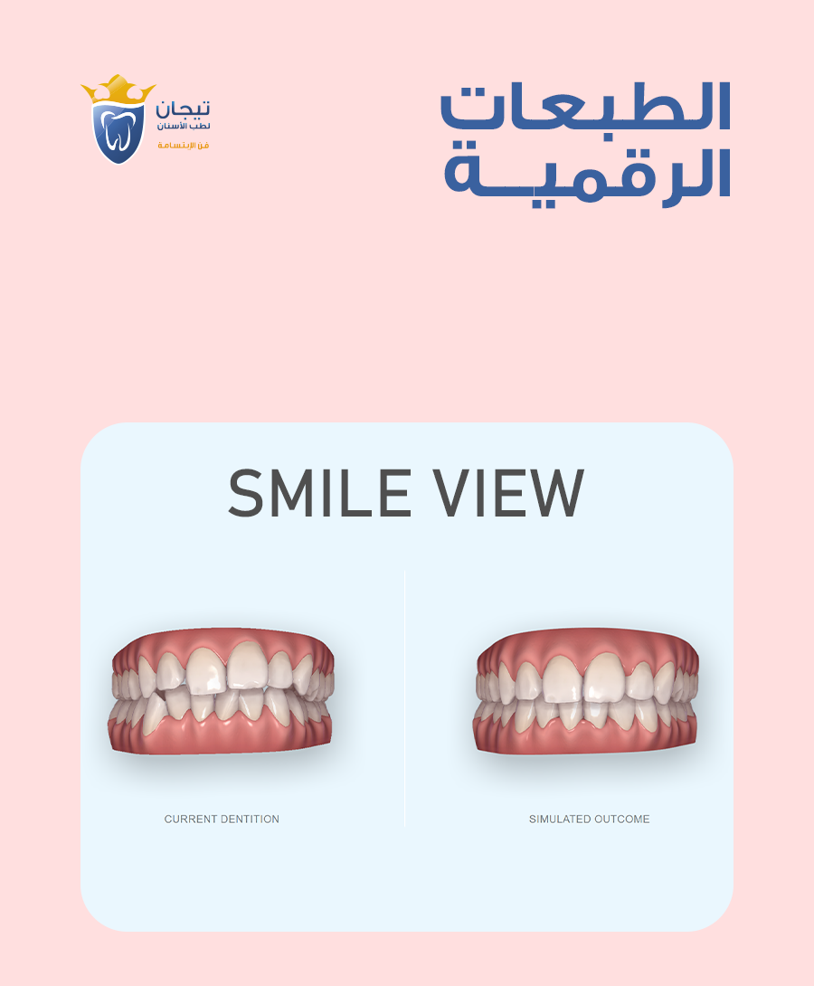 الطبعة الرقمية للاسنان