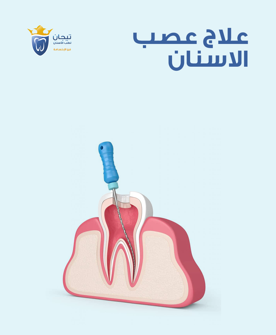علاج عصب الاسنان