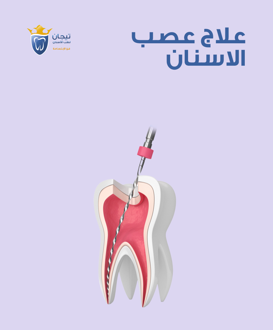 علاج عصب الاسنان