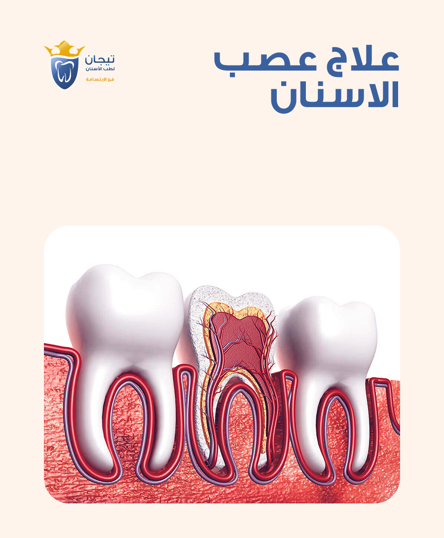 علاج عصب الاسنان