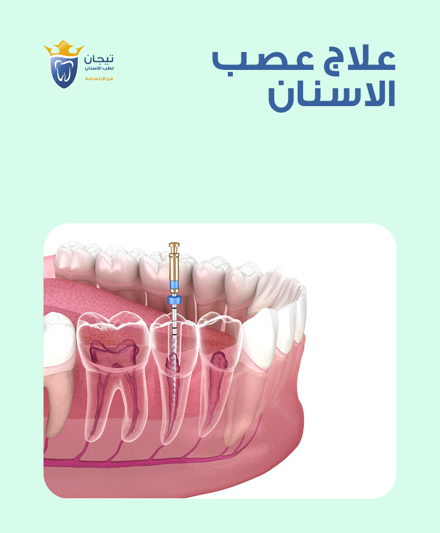 علاج عصب الاسنان