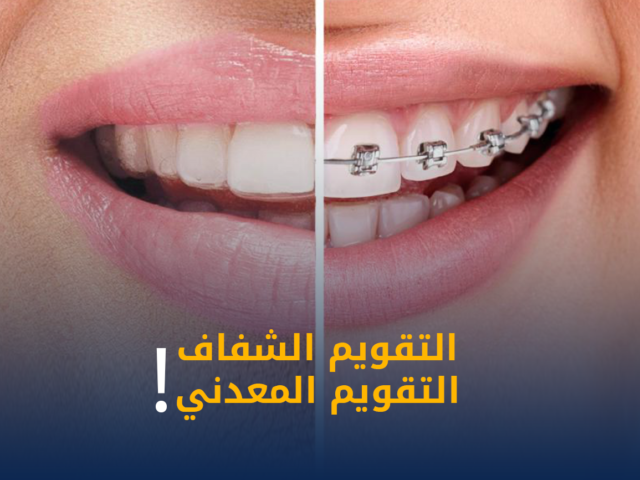التقويم الشفاف,جهاز الاي تيرو iTero,الطبعة الرقمية للاسنان,تقويم انفزلاين الكويت,تقويم شفاف