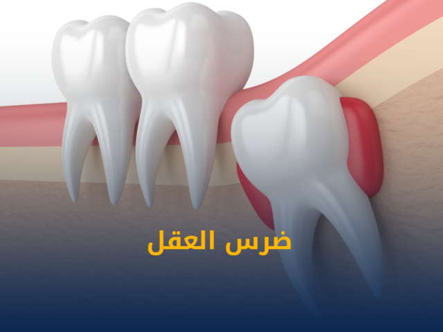 تنظيف وتبييض الاسنان,تبييض الاسنان,تنظيف الاسنان,تنظيف مكثف للأسنان في الكويت,افضل عيادة اسنان