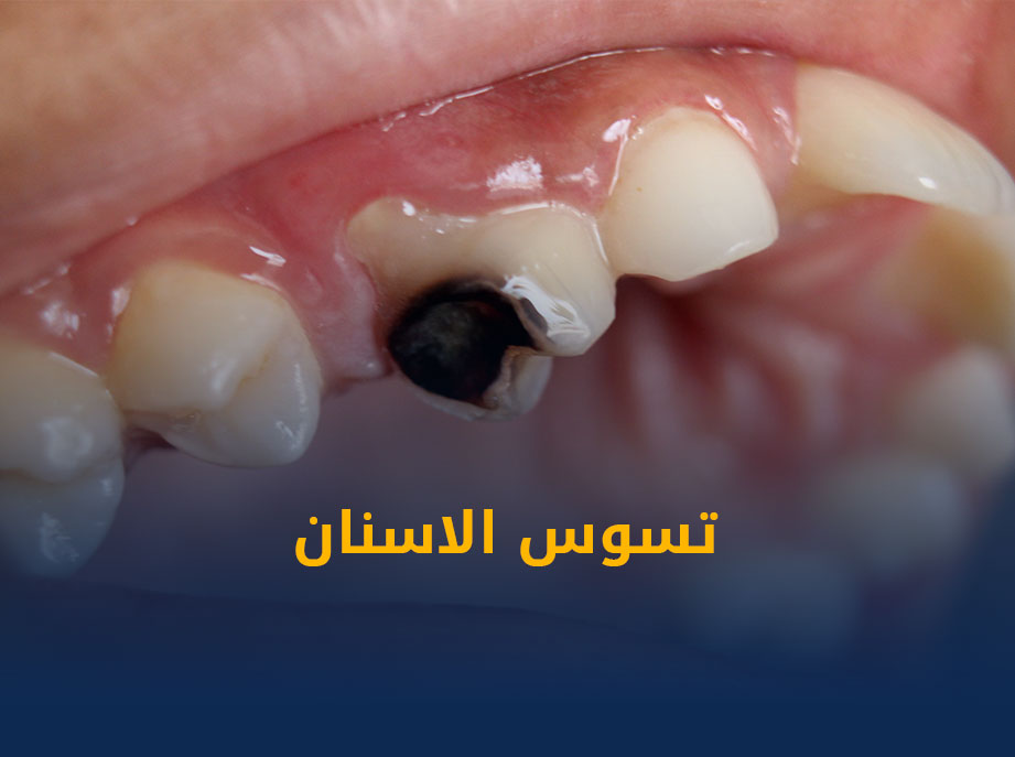 تسوس-الاسنان.jpg