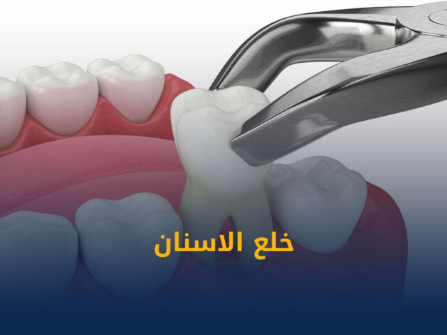 تنظيف وتبييض الاسنان,تبييض الاسنان,تنظيف الاسنان,تنظيف مكثف للأسنان في الكويت,افضل عيادة اسنان