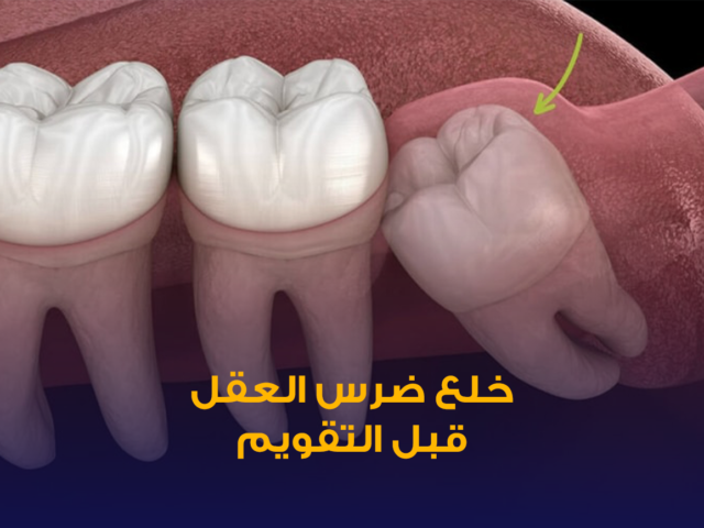 التقويم الشفاف,جهاز الاي تيرو iTero,الطبعة الرقمية للاسنان,تقويم انفزلاين الكويت,تقويم شفاف