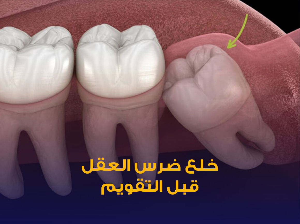خلع-ضرس-العقل-قبل-التقويم.png