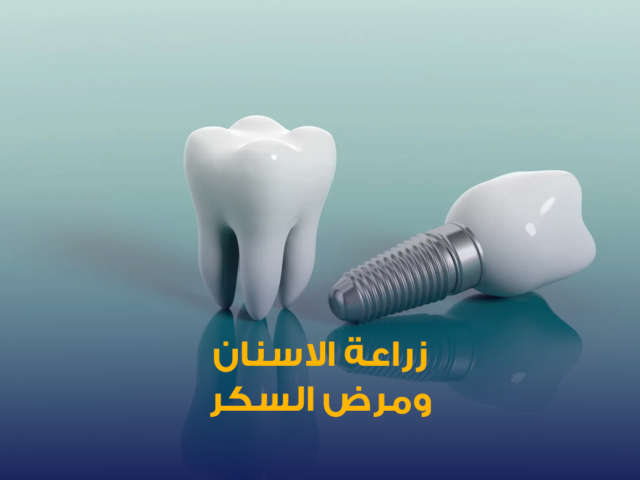 تنظيف وتبييض الاسنان,تبييض الاسنان,تنظيف الاسنان,تنظيف مكثف للأسنان في الكويت,افضل عيادة اسنان