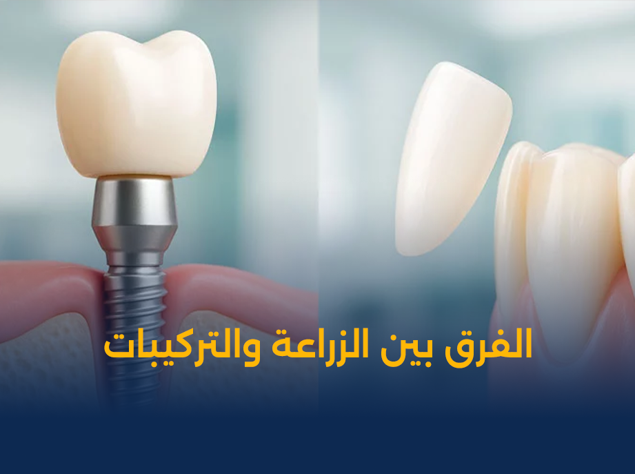 الفرق-بين-زراعة-الأسنان-والتركيبات.png