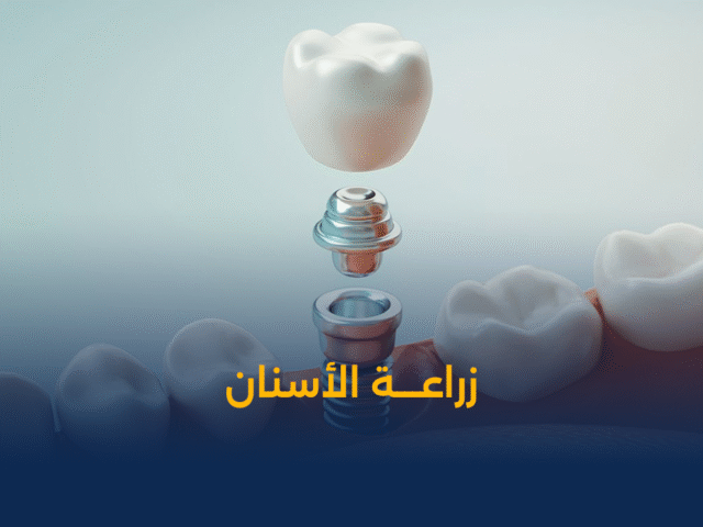 تنظيف وتبييض الاسنان,تبييض الاسنان,تنظيف الاسنان,تنظيف مكثف للأسنان في الكويت,افضل عيادة اسنان