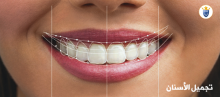 تجميل الاسنان