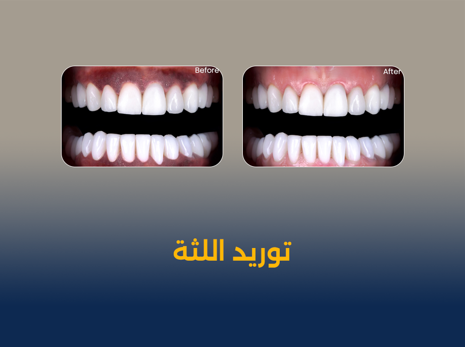 توريد-اللثة.png