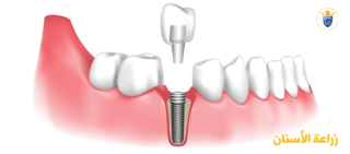 زراعة الاسنان