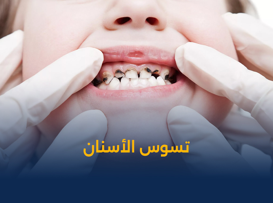 تسوس الأسنان